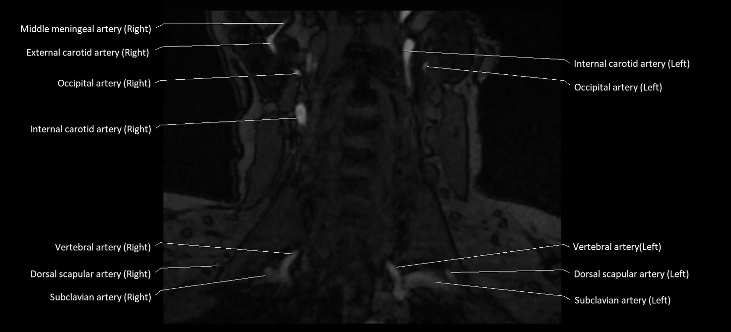 MRA carotid artery anatomy cross sectional 3T coronal image 8.webp